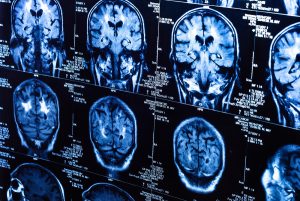 IRM cerveau humain